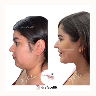 Lower Facelift before and after photo