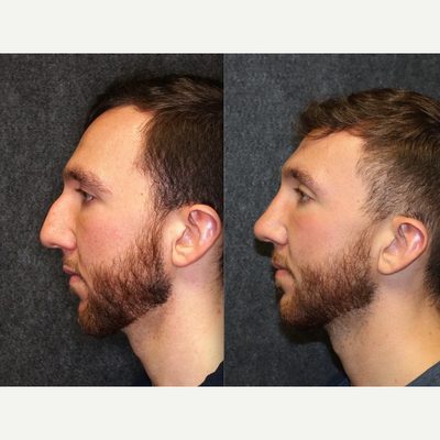 Rhinoplasty before and after photo