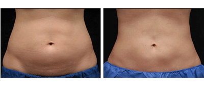 CoolSculpting before and after photo