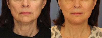 Facelift before and after photo