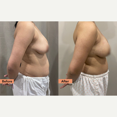 Breast Fat Transfer before and after photo