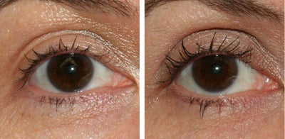 Latisse before and after photo