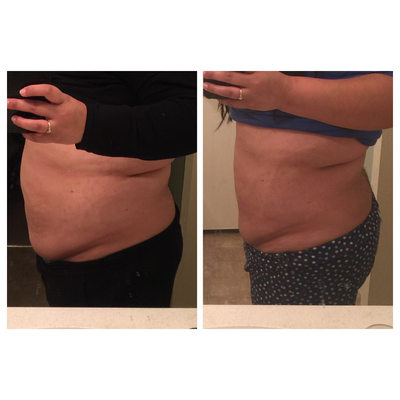 SculpSure before and after photo