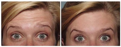 Botox before and after photo