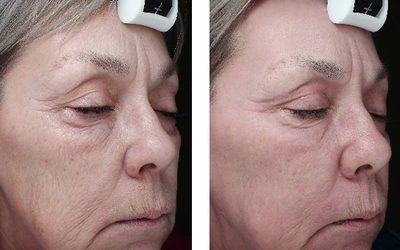 CO2 Laser before and after photo