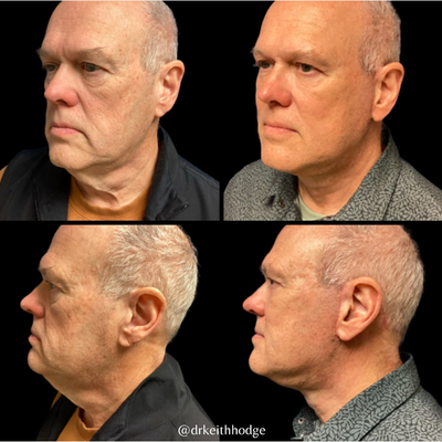 Deep Plane Facelift before and after photo