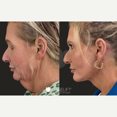 Dysport before and after photo