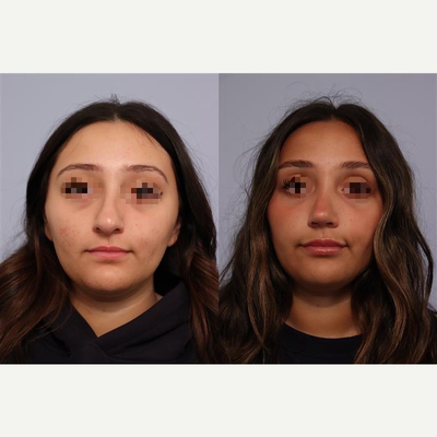 Rhinoplasty before and after photo