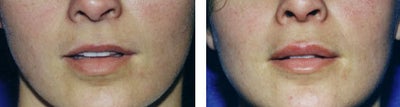 Lip Fillers before and after photo