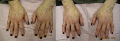 Radiesse before and after photo