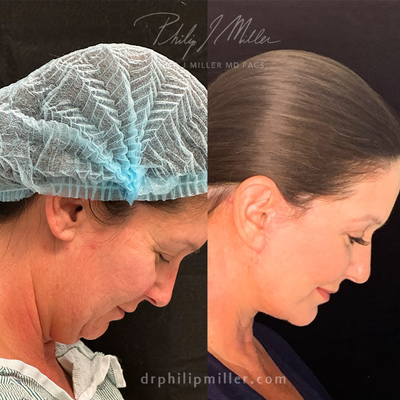 Midface Lift in New York City - Philip Miller MD