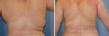 Liposuction before and after photo