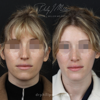 Chin Implant before and after photo