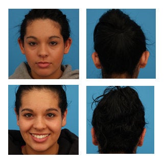 Ear Surgery before and after photo