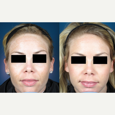 IPL before and after photo