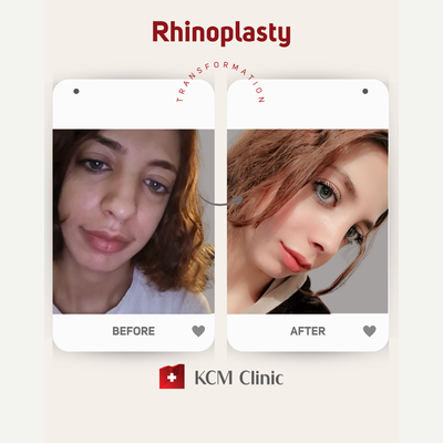 Rhinoplasty before and after photo
