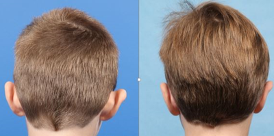 Ear Surgery before and after photo