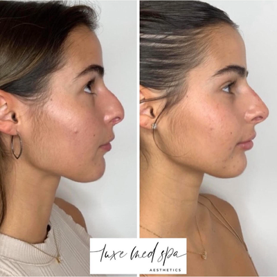 Nonsurgical Nose Job before and after photo