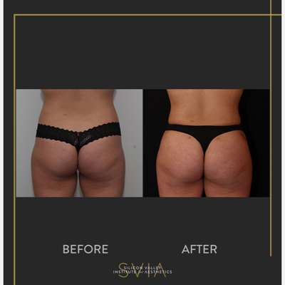 Brazilian Butt Lift before and after photo