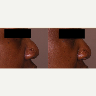 Botox before and after photo