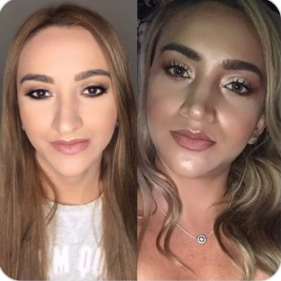 Rhinoplasty before and after photo