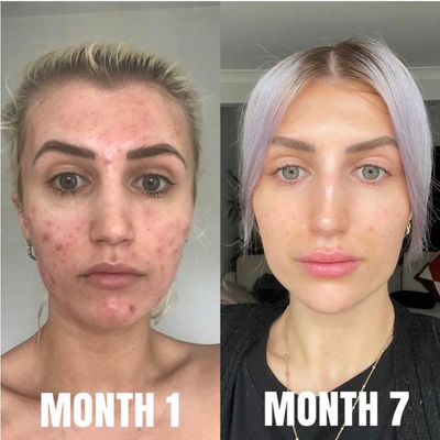 Accutane before and after photo