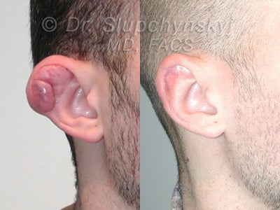 Scar Removal before and after photo