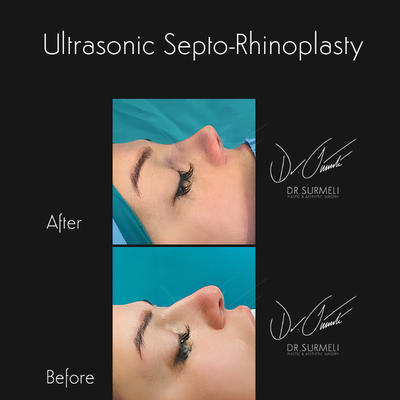 Rhinoplasty before and after photo