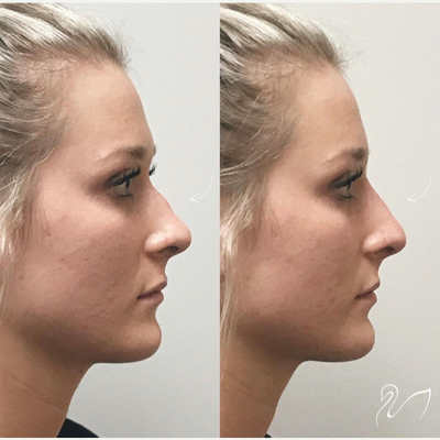 Nonsurgical Nose Job before and after photo