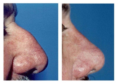 Rhinoplasty before and after photo