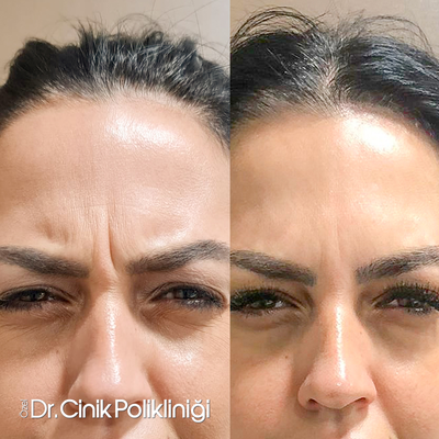 Botox before and after photo