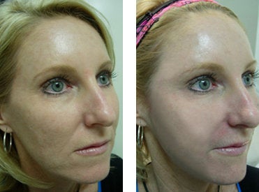 Sculptra before and after photo