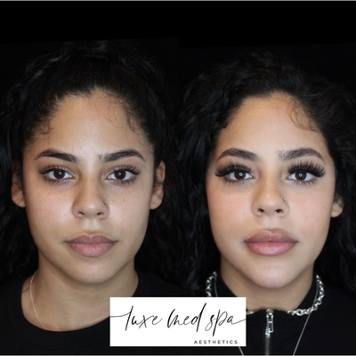 Dermal Fillers before and after photo