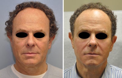 Restylane Lyft before and after photo