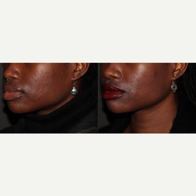 ProFractional Laser before and after photo