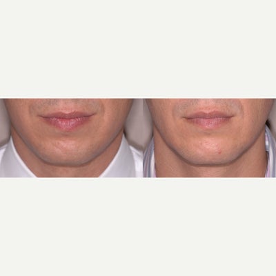 Chin Implant before and after photo