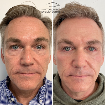 CO2 Laser before and after photo