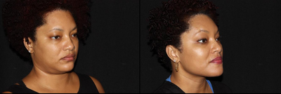 Ultherapy before and after photo