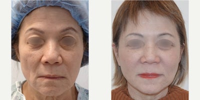 55-64 year old woman treated with Facelift, MACS Facelift, Eyelid Surgery - This patient received a MACS Facelift as well as a bilateral lower blepharoplasty with Fat Grafting. Patient photos are 4 months post op and she is overjoyed with her results! She looks rejuvenated and 20 years younger. Dr. Lee's expertise is highlighted in this beautiful transformation.