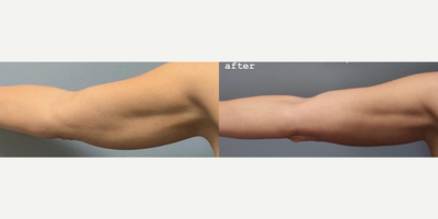 Woman treated with Evolve - Woman treated with Evolve