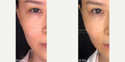 Woman treated with Nonsurgical Facelift, NovaThreads - Woman treated with Nonsurgical Facelift, NovaThreads