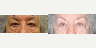 65-74 year old woman treated with Eyelid Surgery - Bilateral upper eyelid blepharoplasty