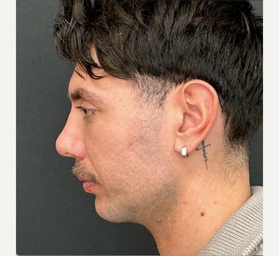 25-34 year old man treated with Chin Implant - Chin Implant