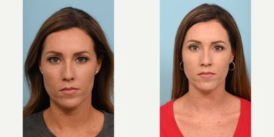 35-44 year old woman treated with Double Eyelid Surgery - Quad Blepharoplasty