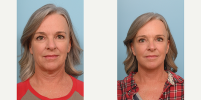 55-64 year old woman treated with Double Eyelid Surgery - This patient in her 50s was concerned with wrinkles, volume loss and jowling. The doctor performed an extended deep plane face and neck lift with fat transfer, upper and lower blepharoplasty and CO2 laser to lift and contour her natural beauty.