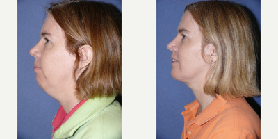 25-34 year old woman treated with Chin Implant - Chin implant makes a great jawline change, especially when combined with liposuction of the neck.