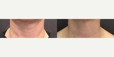 45-54 year old woman treated with Nonsurgical Neck Lift, Botox - Treated by Aubrey Houchin, RN