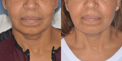 55-64 year old woman treated with Facelift - Older female patient receives a lasting face-lift