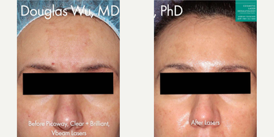35-44 year old woman treated with PicoWay - PicoWay, Clear + Brilliant, and Vbeam lasers used to remove brown patch on forehead by Dr. Wu.