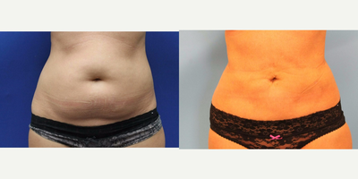 42 year old woman treated with Slim Lipo - despite diet and exercises, patient c/o not loosing the fat in Abdomen and Flanks